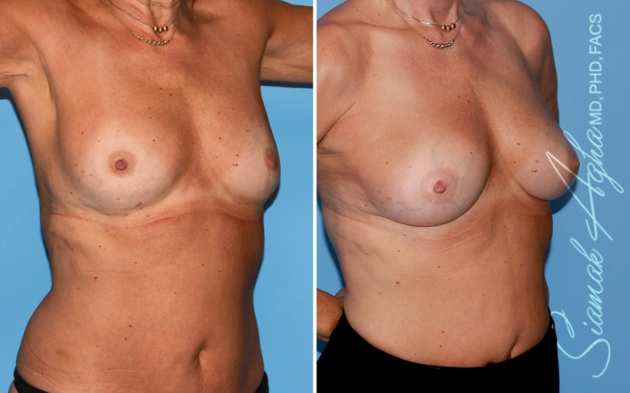Breast Fat Transfer Before & After