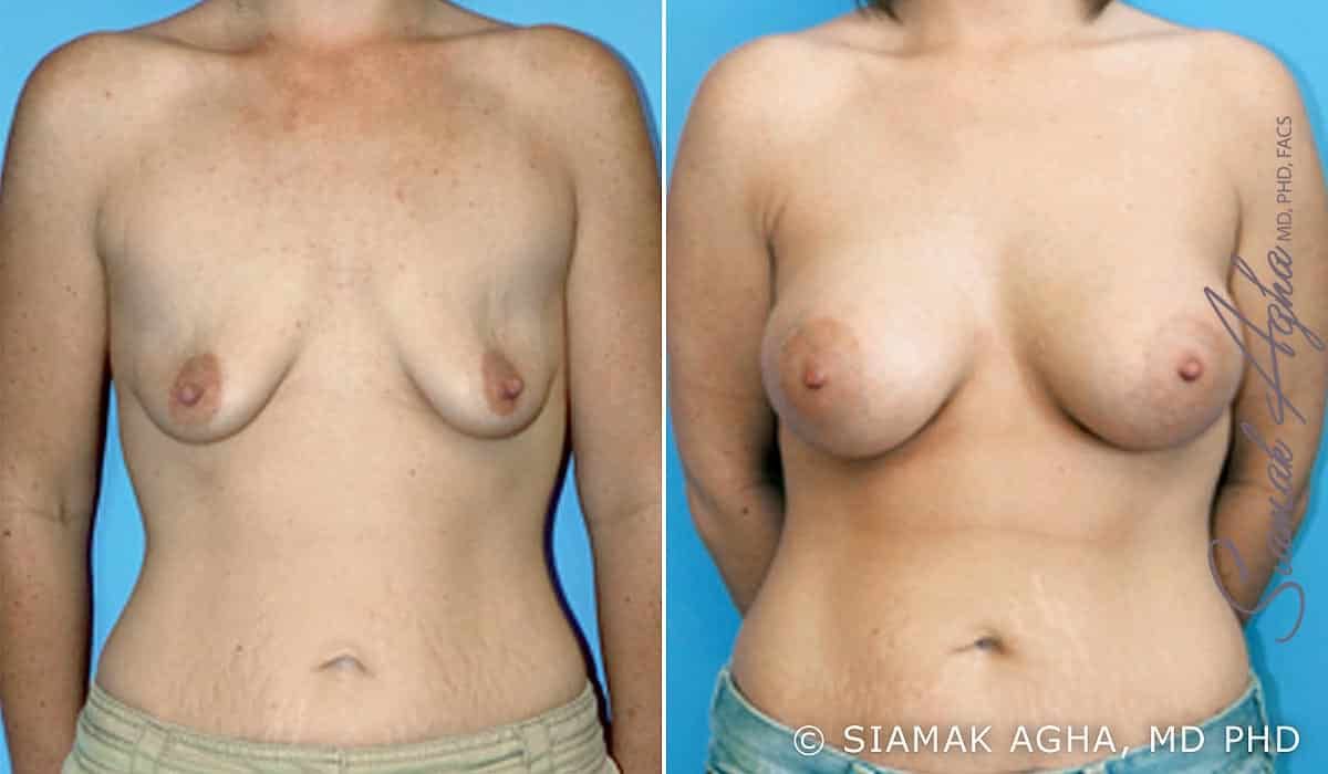 Breast Lift With Augmentation Before & After