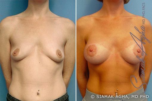 Breast Lift With Augmentation Before & After