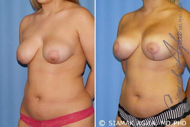 Breast Lift With Augmentation Before & After