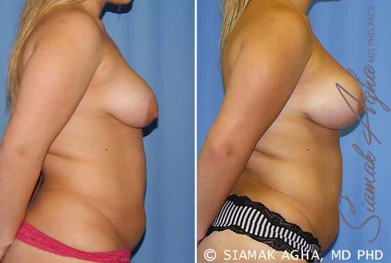 Breast Lift With Augmentation Before & After
