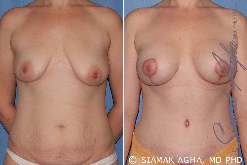 Breast Lift With Augmentation Before & After