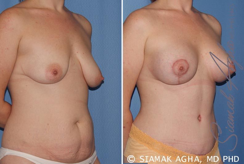 Breast Lift With Augmentation Before & After