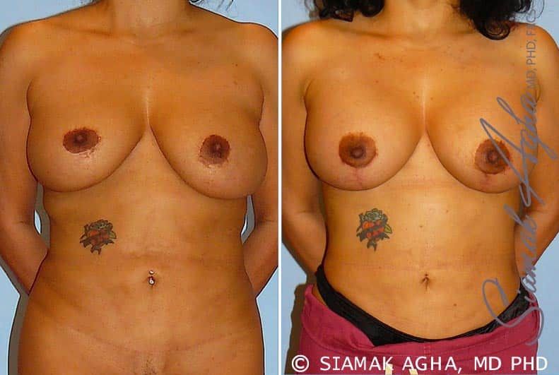 Breast Lift With Augmentation Before & After
