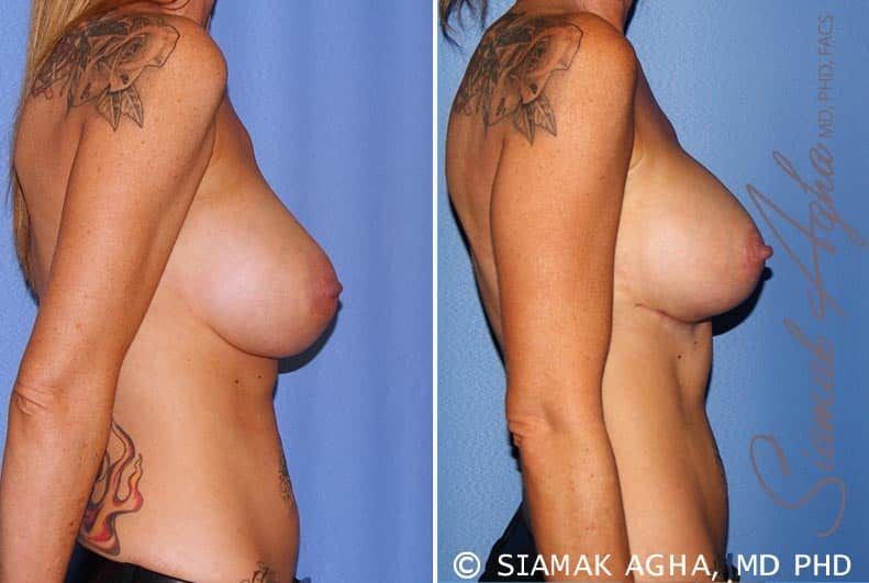 Breast Lift With Augmentation Before & After