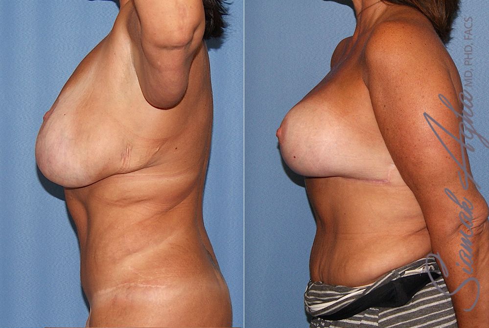 Breast Lift With Augmentation Before & After
