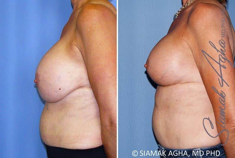 Breast Lift With Augmentation Before & After
