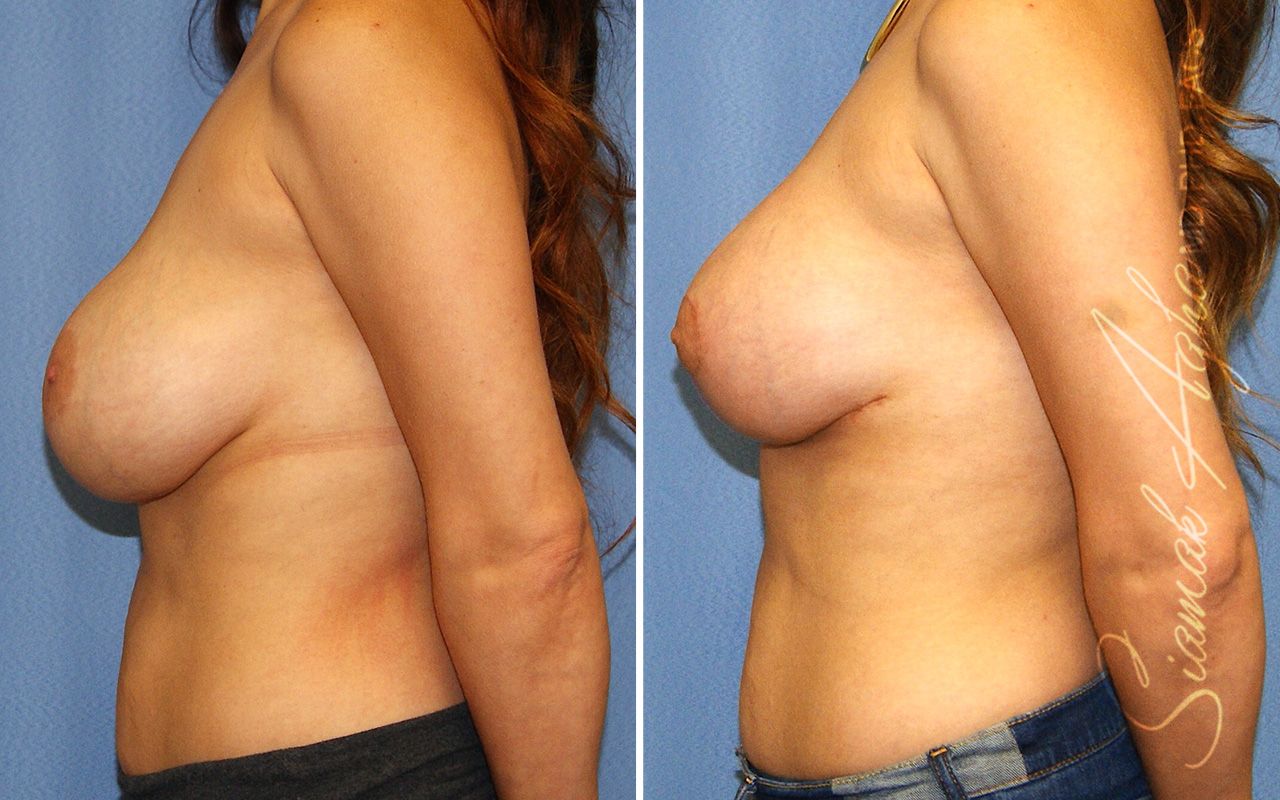 Breast Lift With Augmentation Before & After