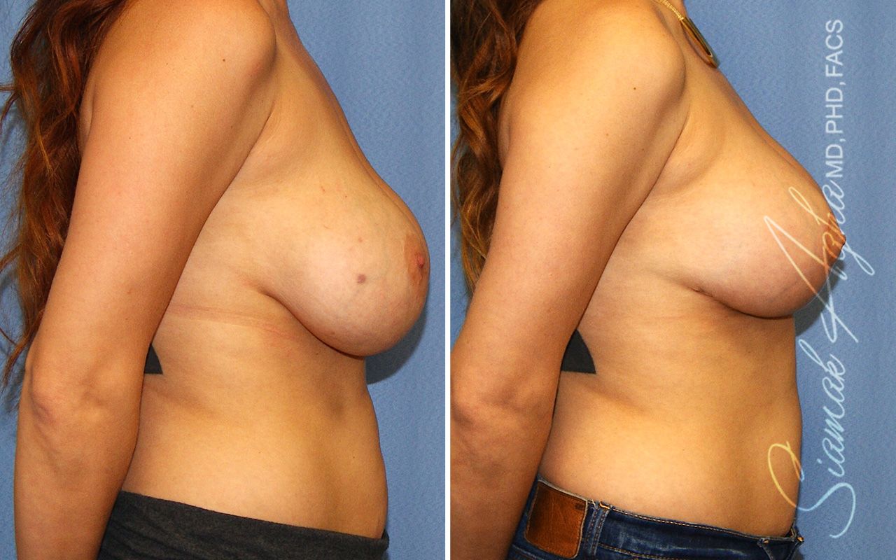 Breast Lift With Augmentation Before & After