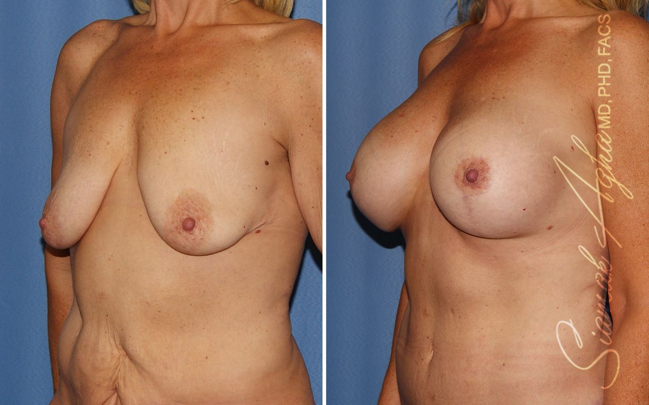 Breast Lift With Augmentation Before & After
