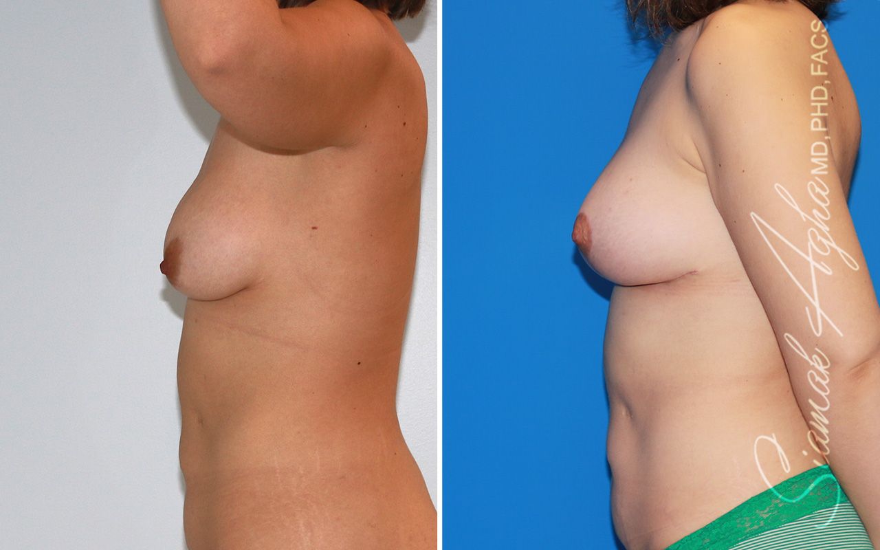 Breast Lift With Augmentation Before & After