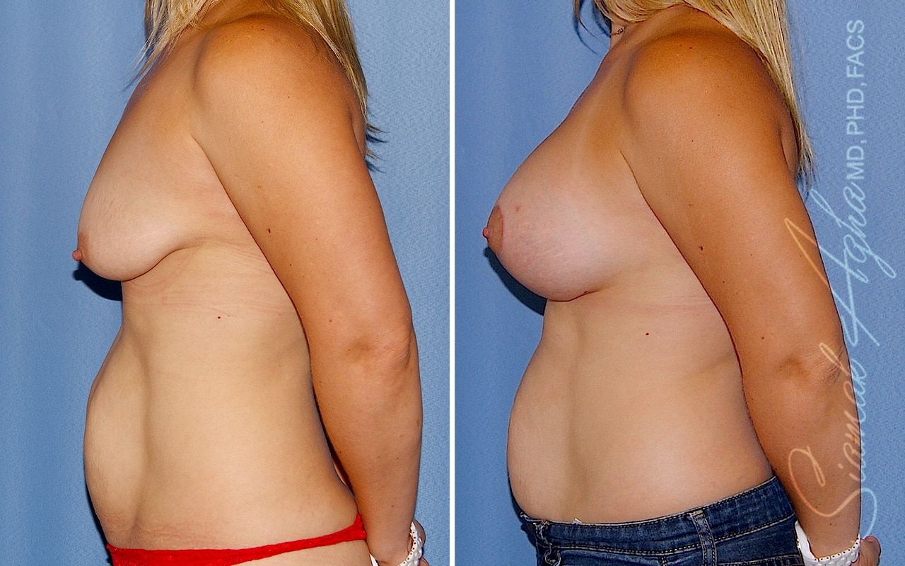 Breast Lift With Augmentation Before & After