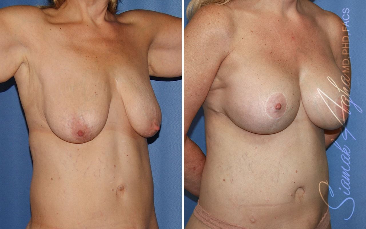 Breast Lift With Augmentation Before & After