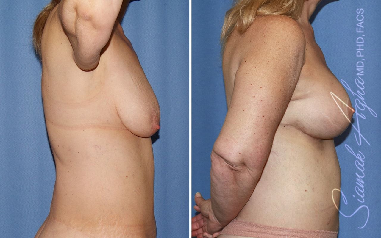 Breast Lift With Augmentation Before & After