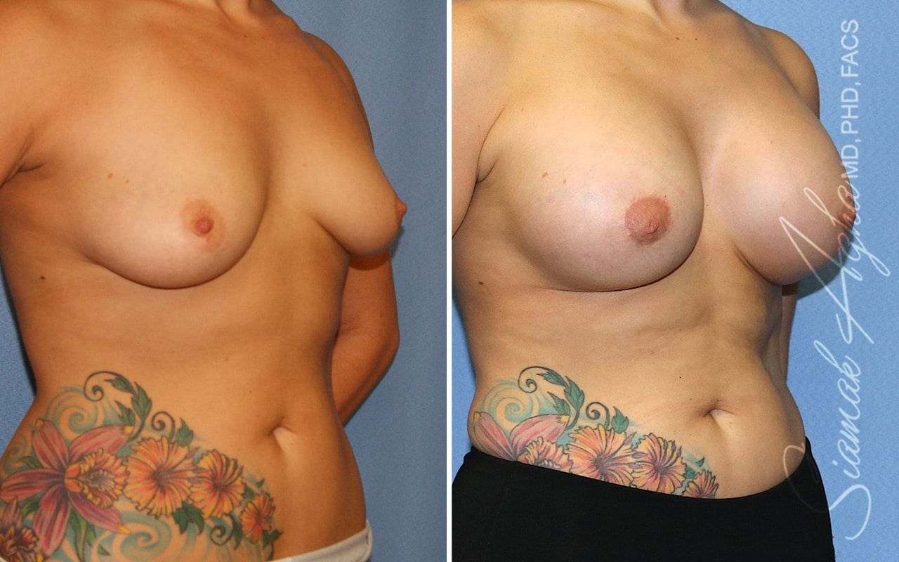 Breast Lift With Augmentation Before & After