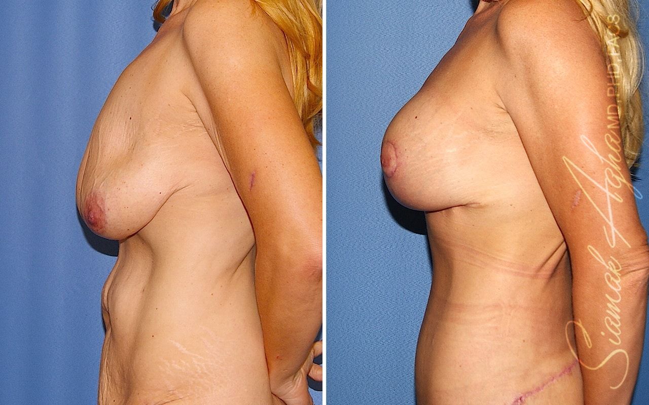 Breast Lift With Augmentation Before & After