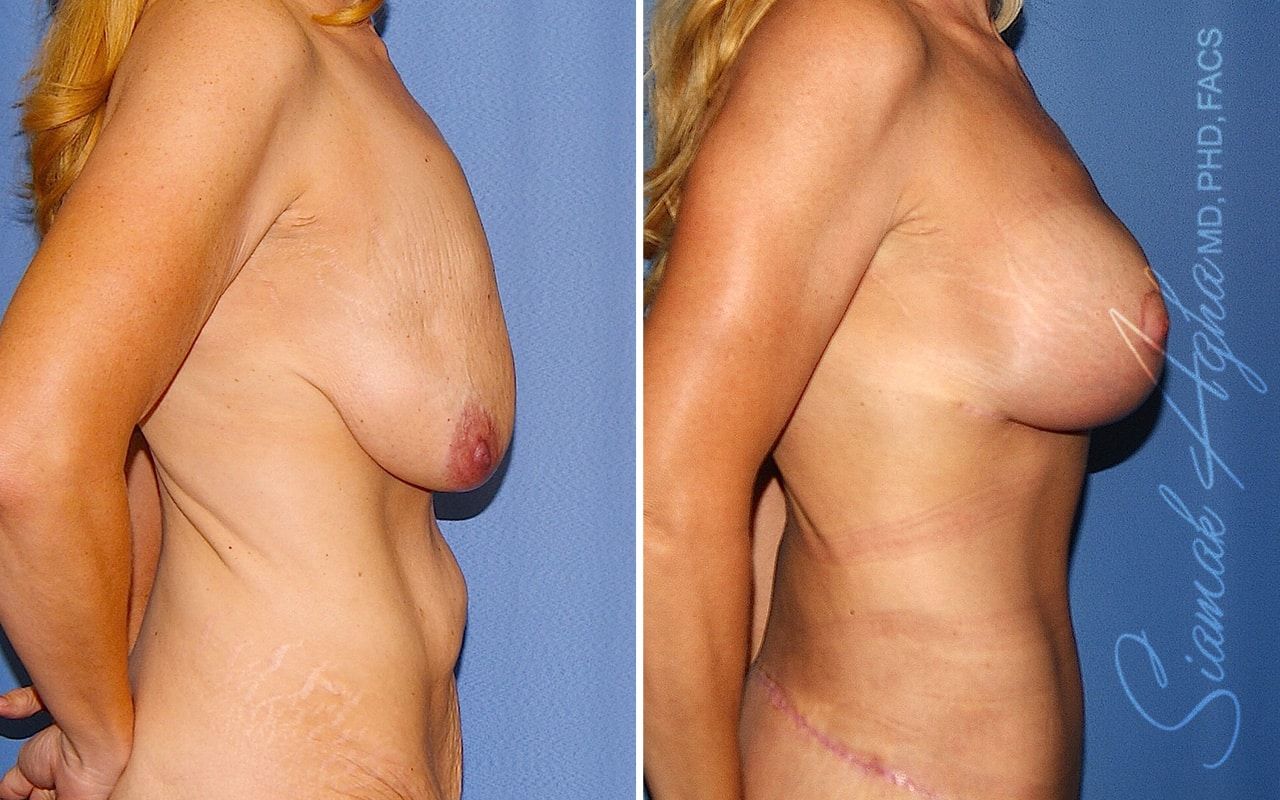Breast Lift With Augmentation Before & After