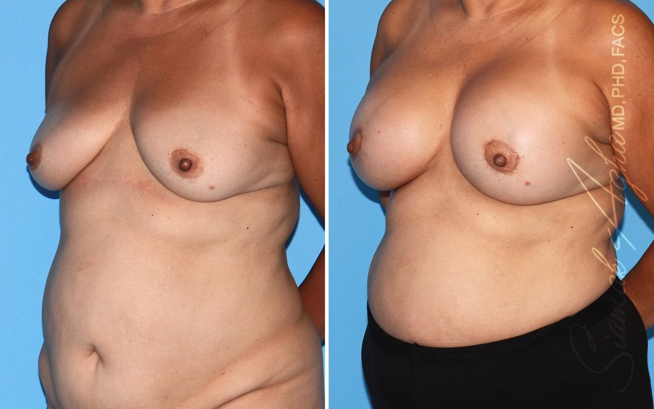 Breast Lift With Augmentation Before & After