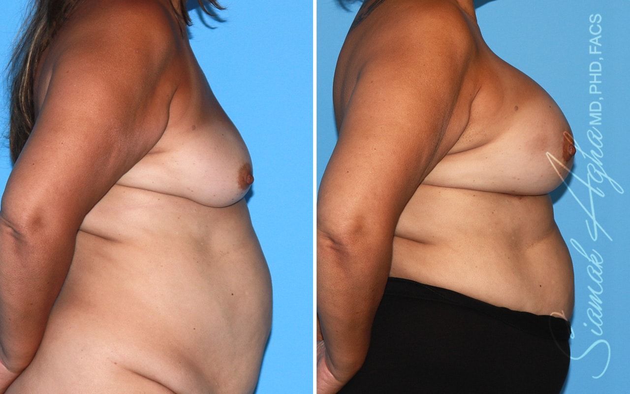 Breast Lift With Augmentation Before & After