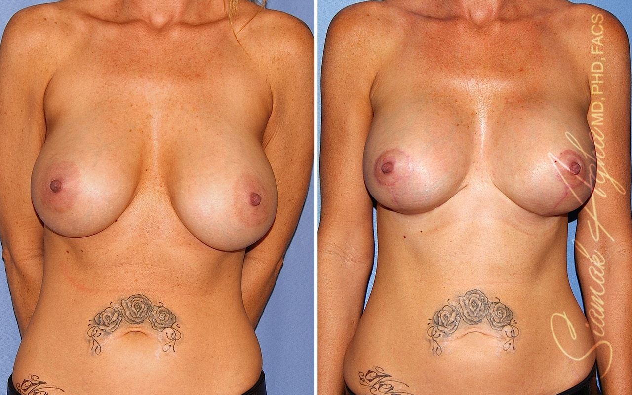 Breast Lift With Augmentation Before & After