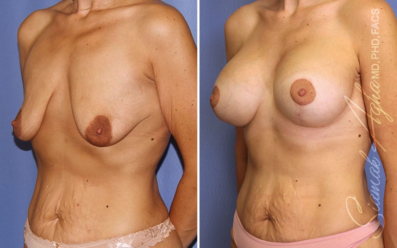 Breast Lift With Augmentation Before & After