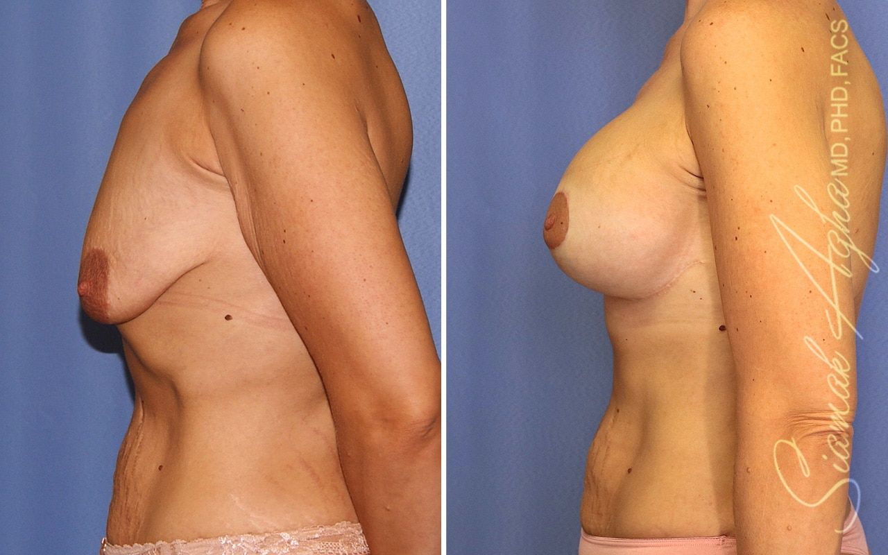 Breast Lift With Augmentation Before & After