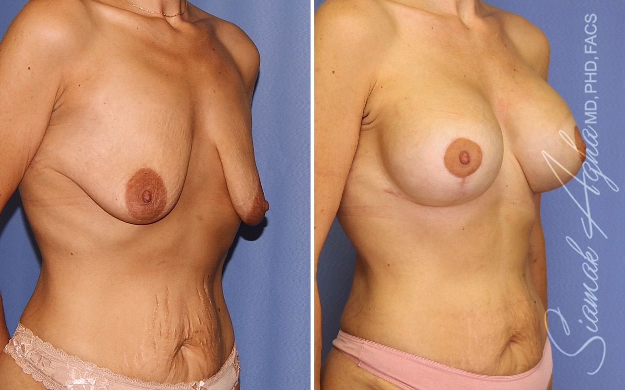 Breast Lift With Augmentation Before & After