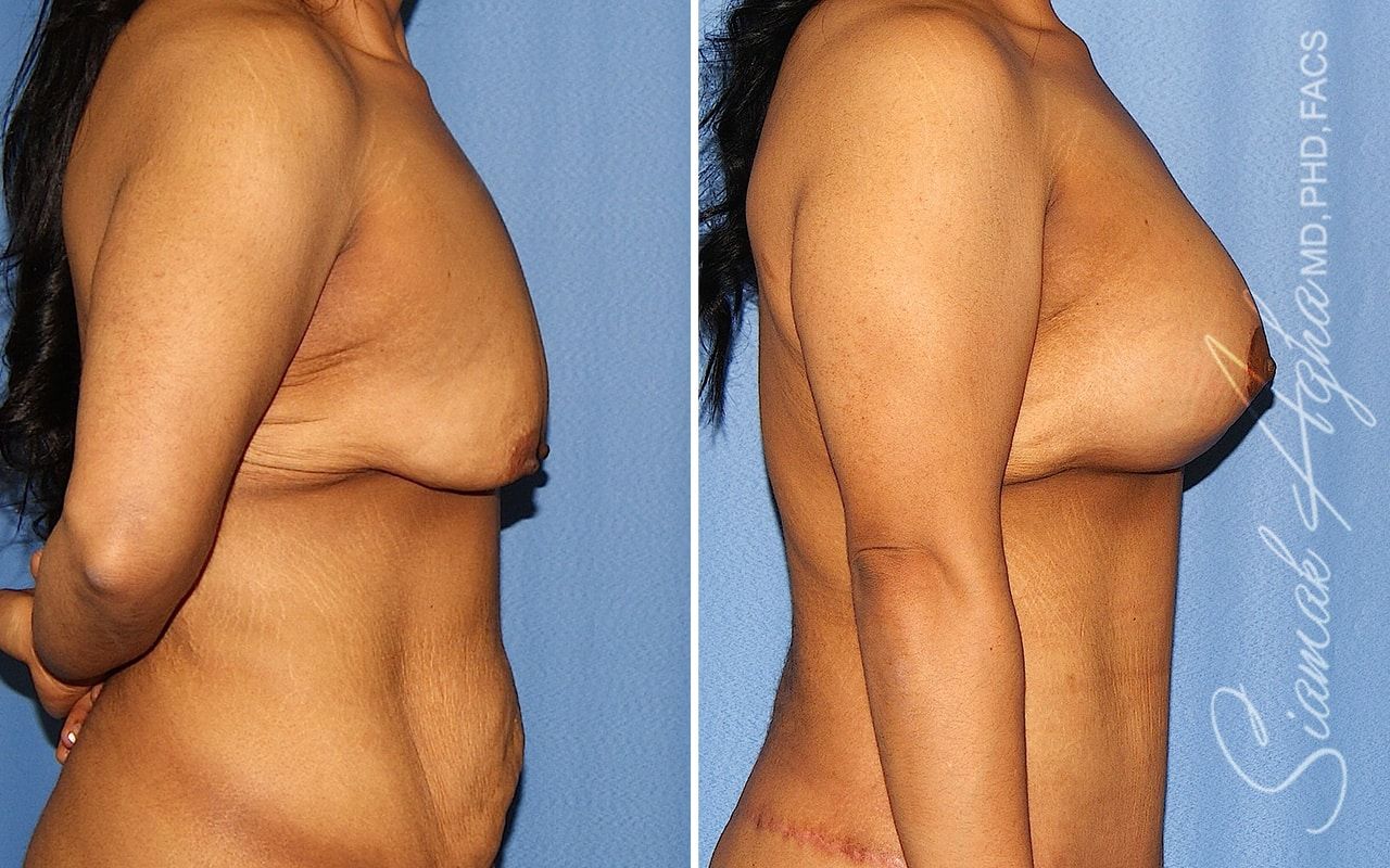 Breast Lift With Augmentation Before & After