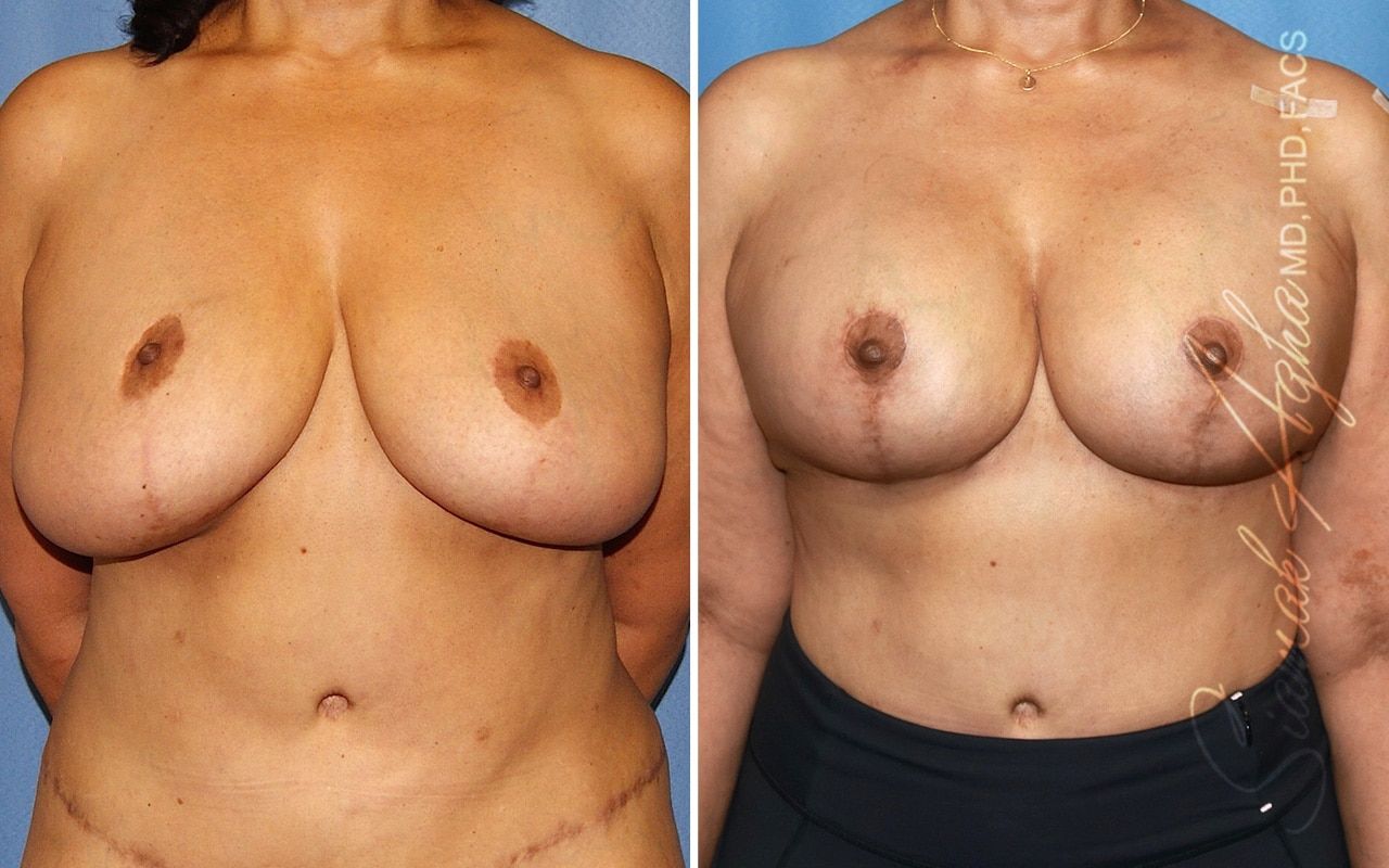 Breast Lift With Augmentation Before & After