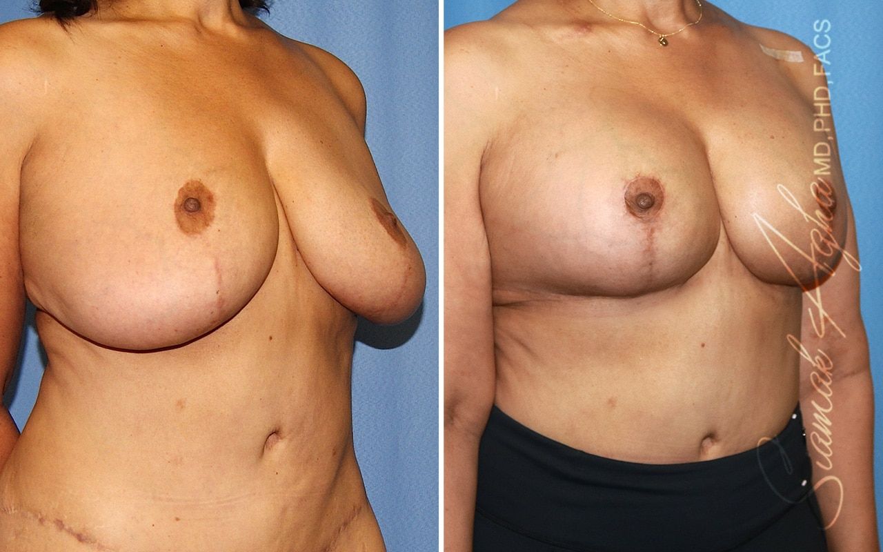 Breast Lift With Augmentation Before & After
