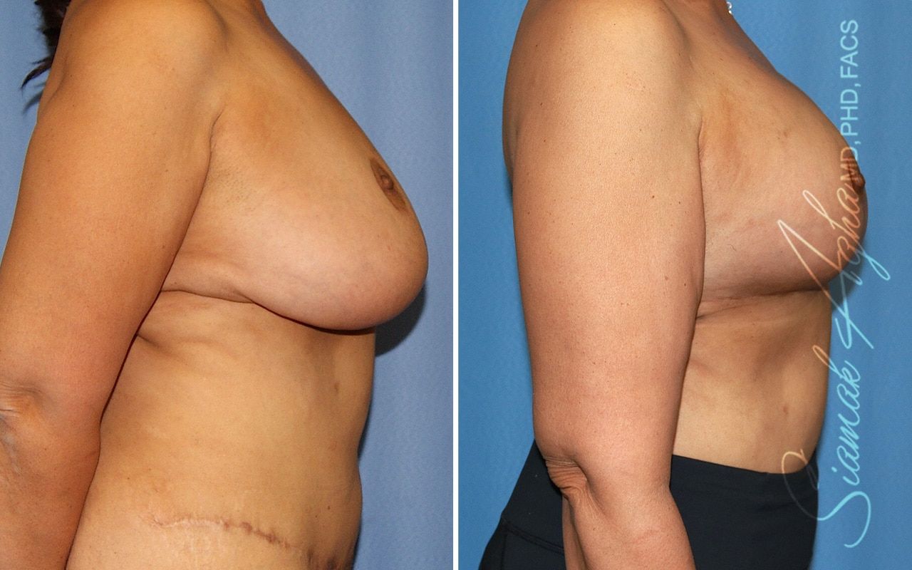 Breast Lift With Augmentation Before & After