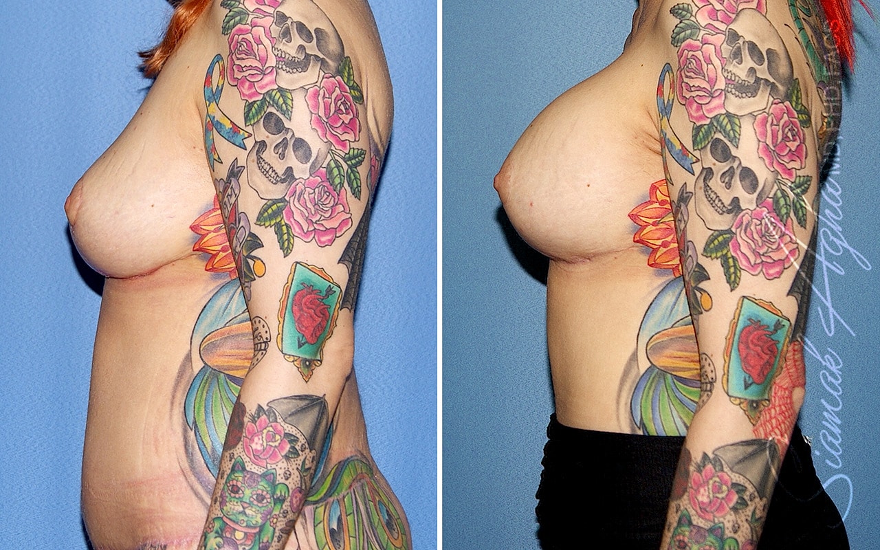 Breast Lift With Augmentation Before & After