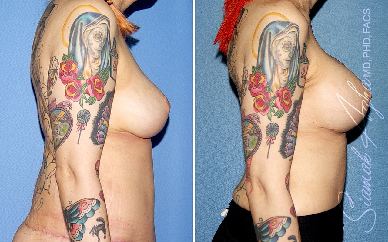 Breast Lift With Augmentation Before & After