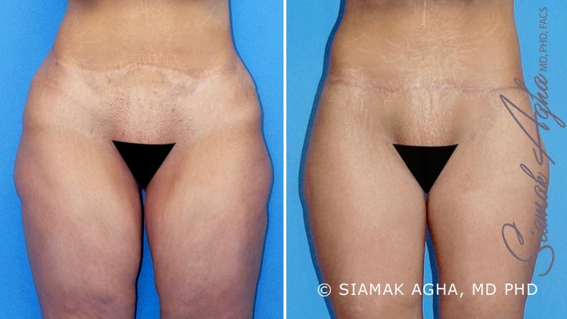 Vertical Thigh Lift Before & After
