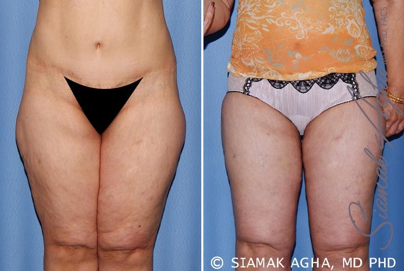 Vertical Thigh Lift Before & After