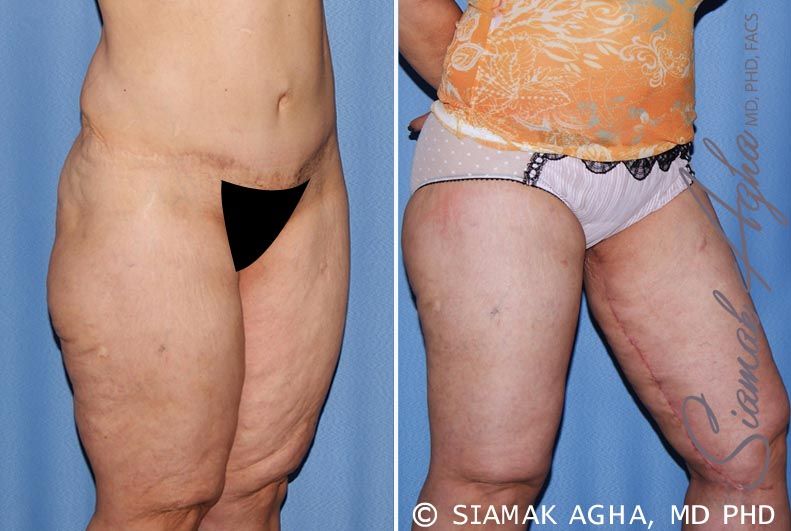 Vertical Thigh Lift Before & After