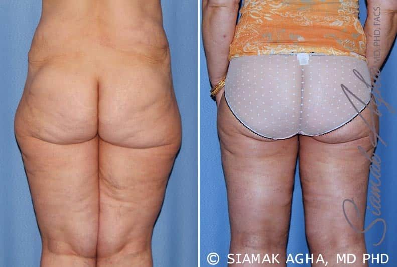 Vertical Thigh Lift Before & After