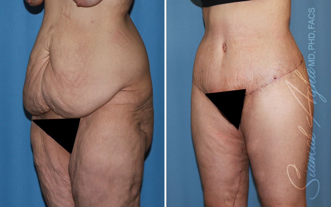 Vertical Thigh Lift Before & After