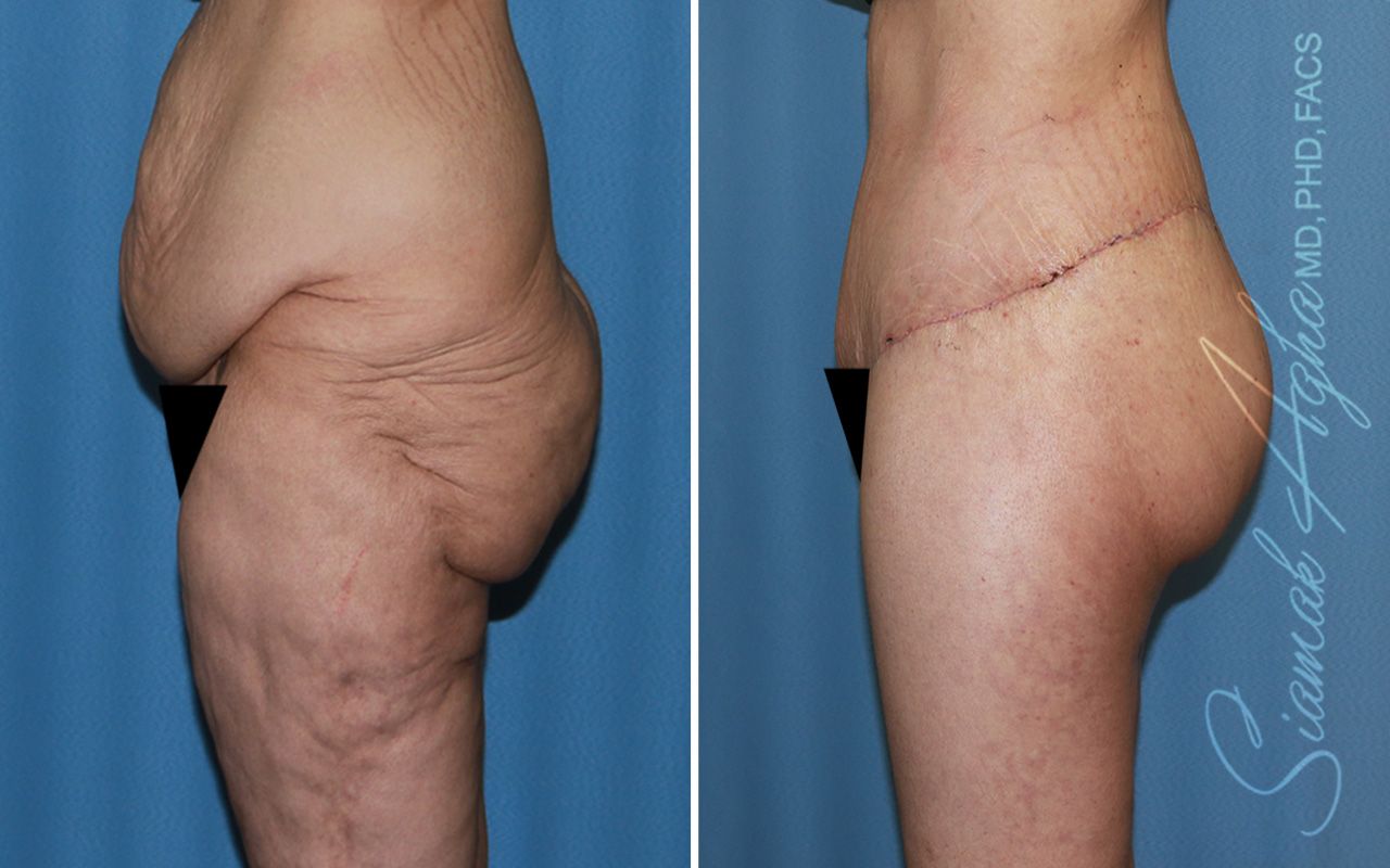 Vertical Thigh Lift Before & After