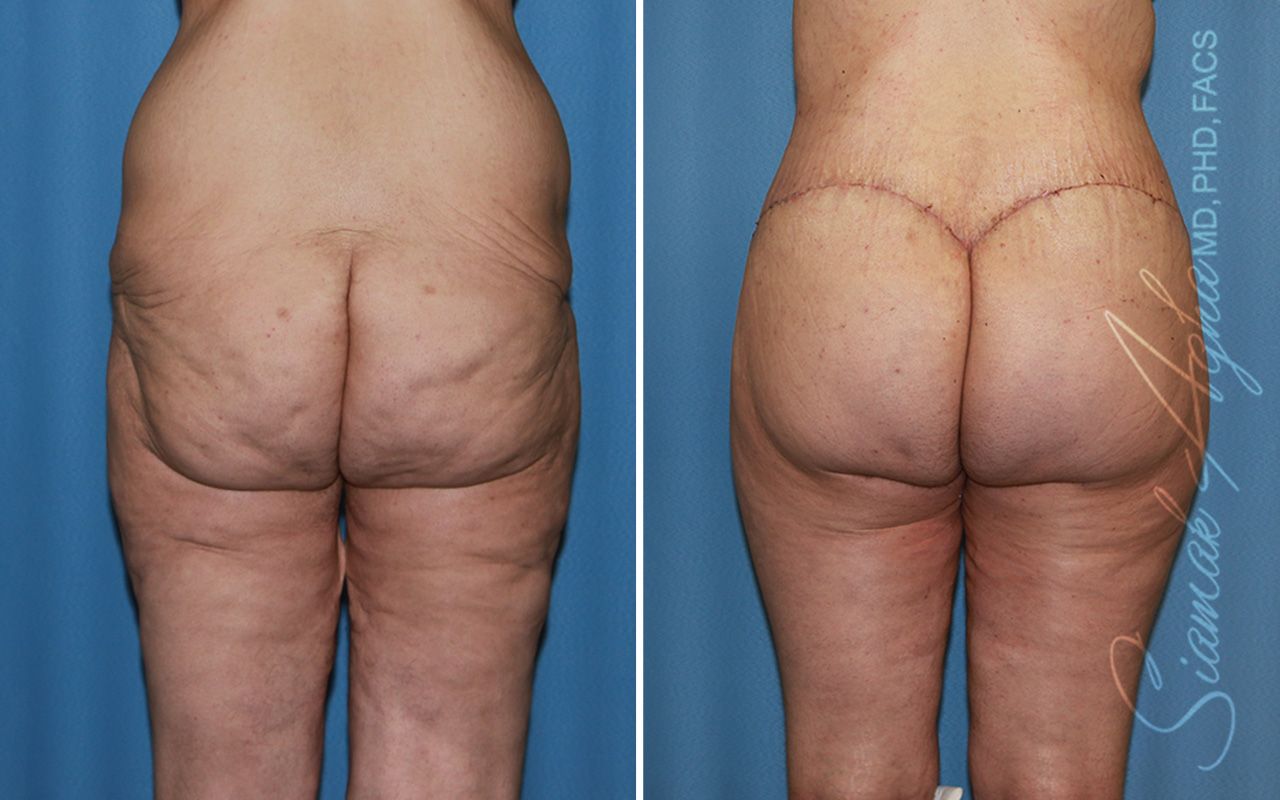 Vertical Thigh Lift Before & After