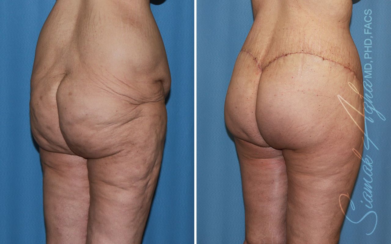 Vertical Thigh Lift Before & After