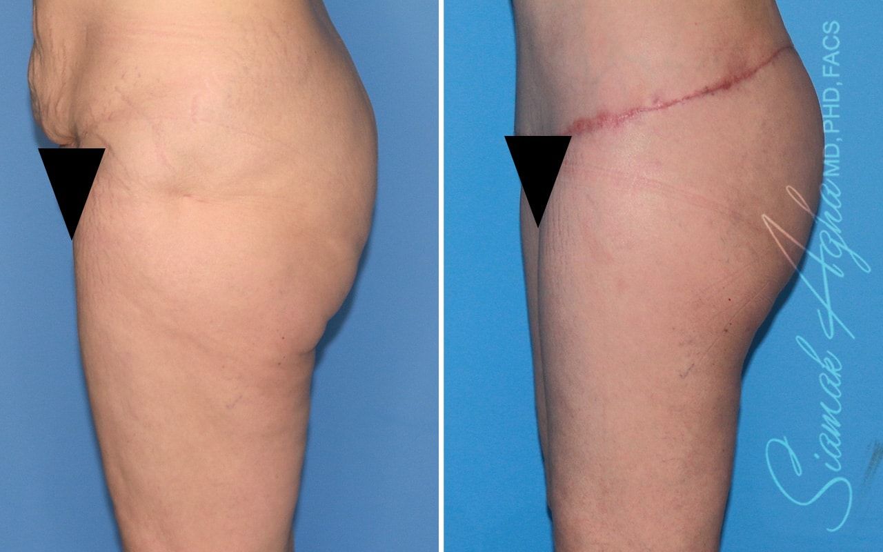 Vertical Thigh Lift Before & After