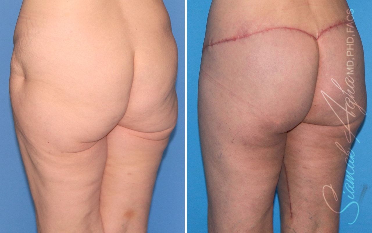 Vertical Thigh Lift Before & After