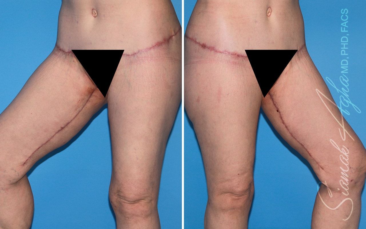 Vertical Thigh Lift Before & After