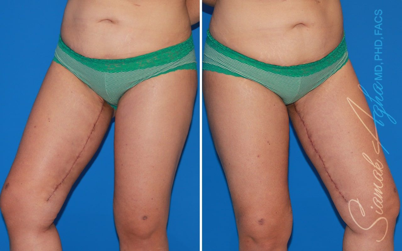 Vertical Thigh Lift Before & After