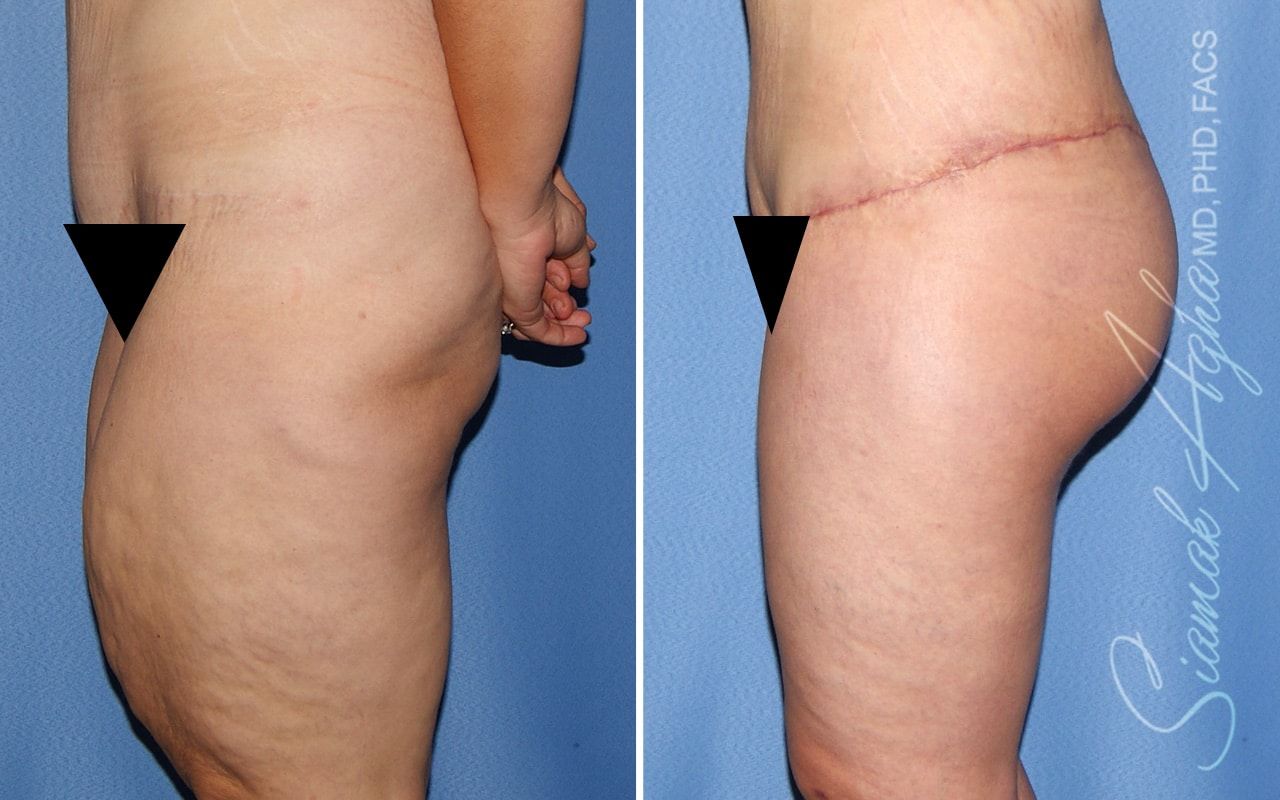 Vertical Thigh Lift Before & After