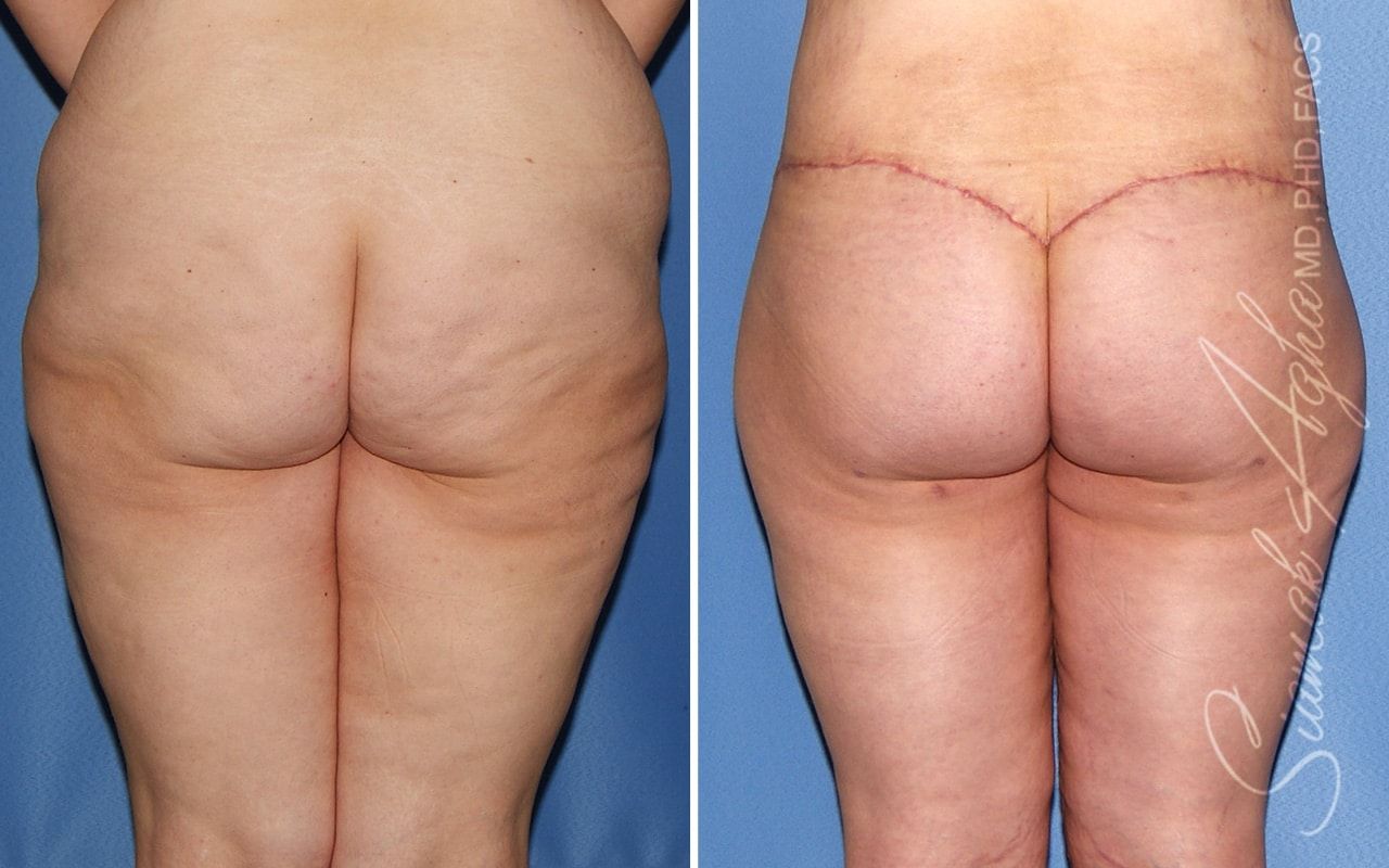 Vertical Thigh Lift Before & After