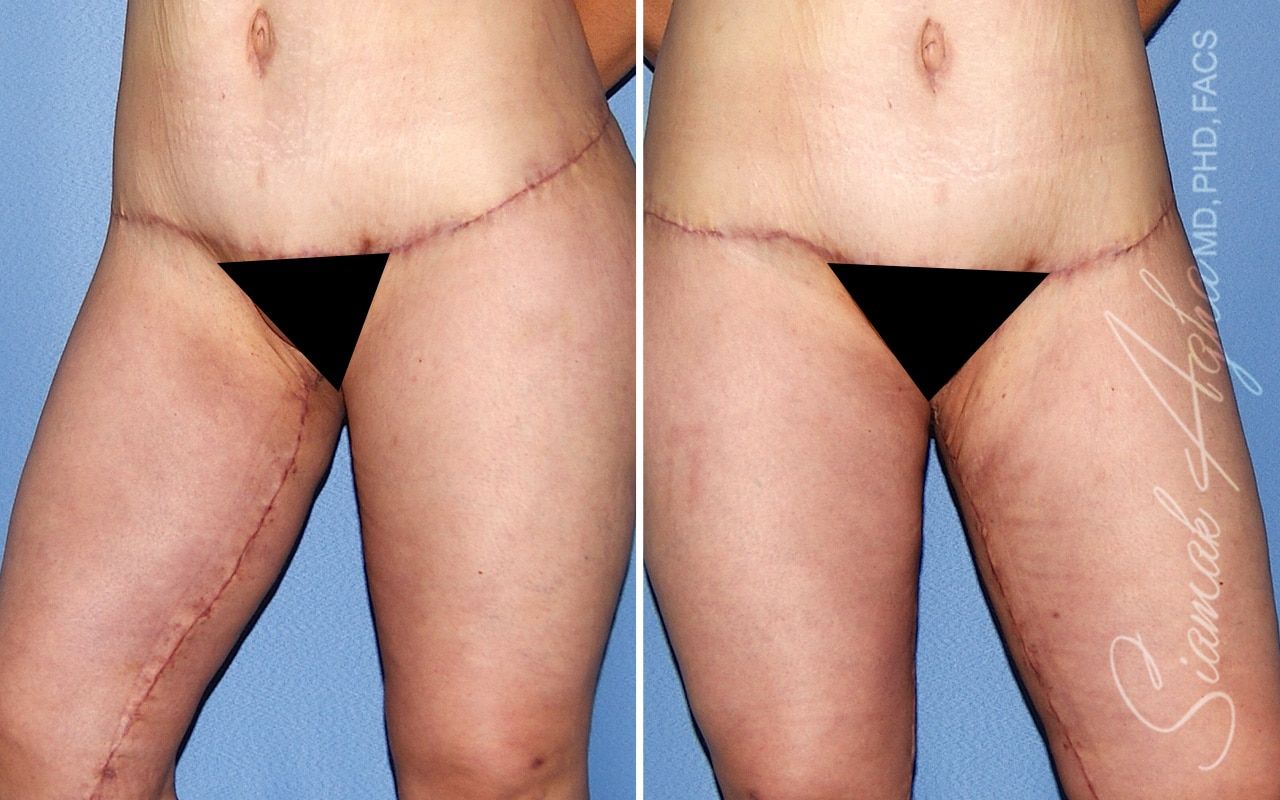 Vertical Thigh Lift Before & After