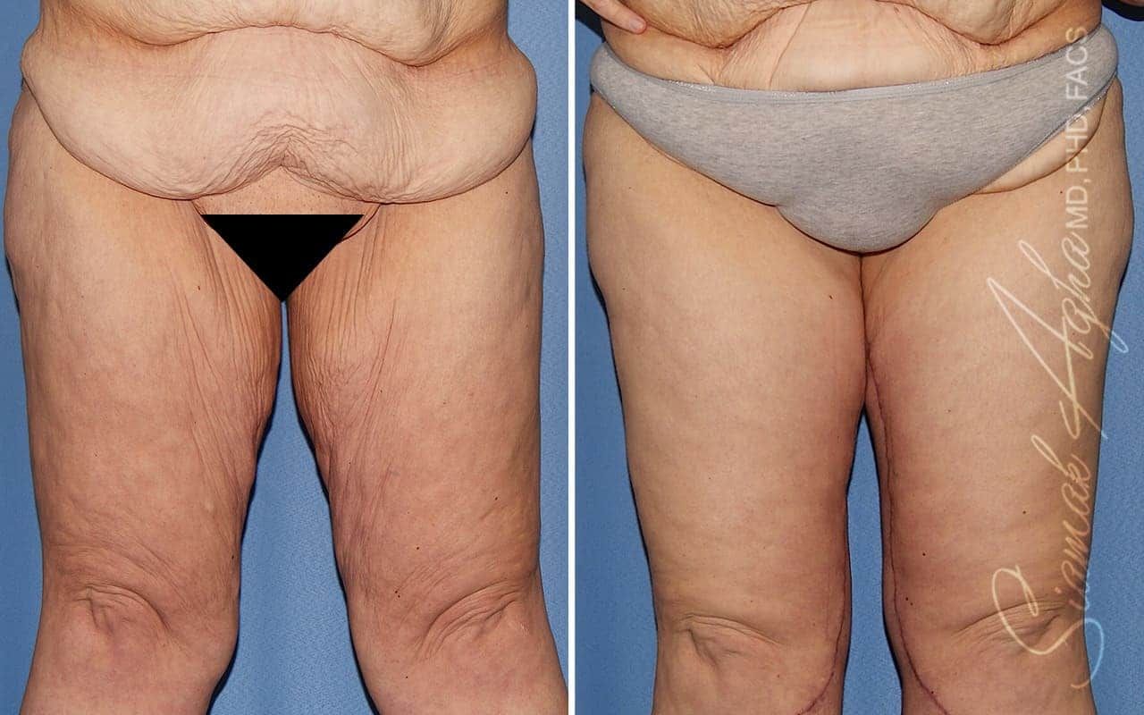 Vertical Thigh Lift Before & After
