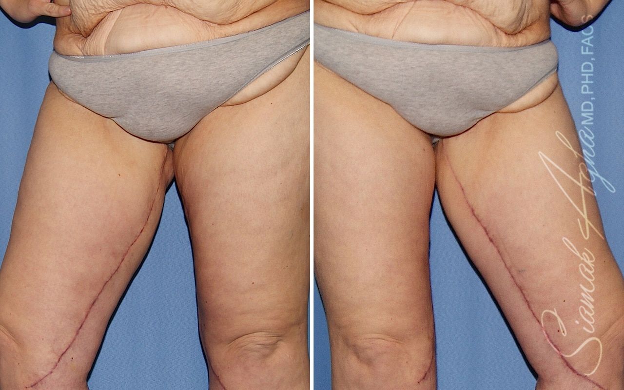 Vertical Thigh Lift Before & After